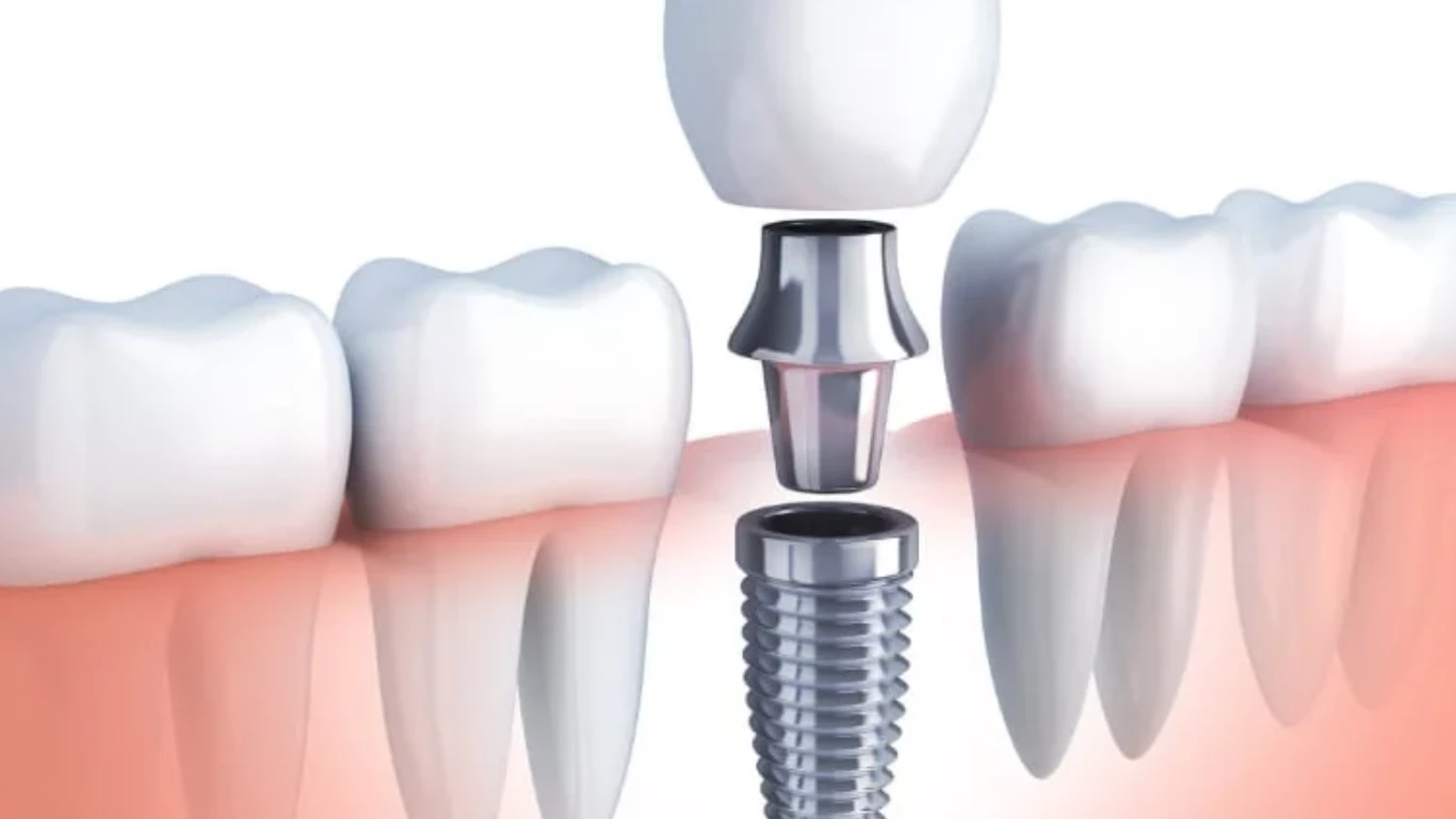 Are Dental Implants Right for You?: Options for a Permanent Tooth Replacement