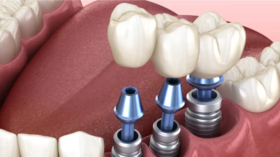 Cost Insights Estimating Dental Implants Affordably