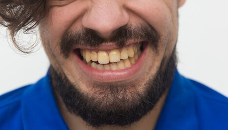 Discolored Teeth