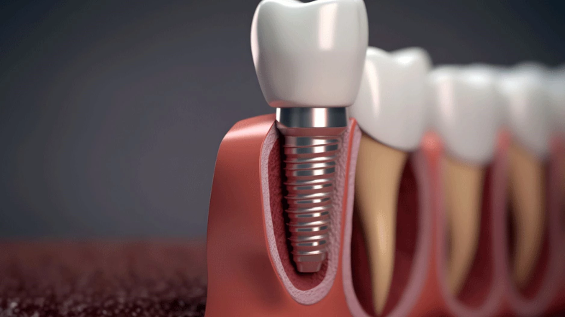 Full Mouth Dental Implants A Revolutionary Solution for Total Tooth Loss