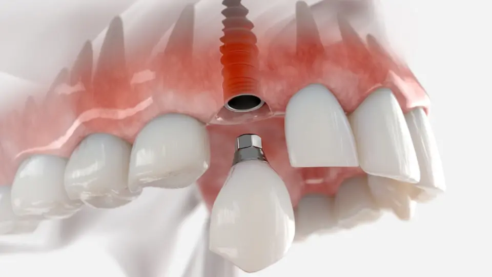 Gum Health Concerns Diagnosing and Treating Gum Disease-1