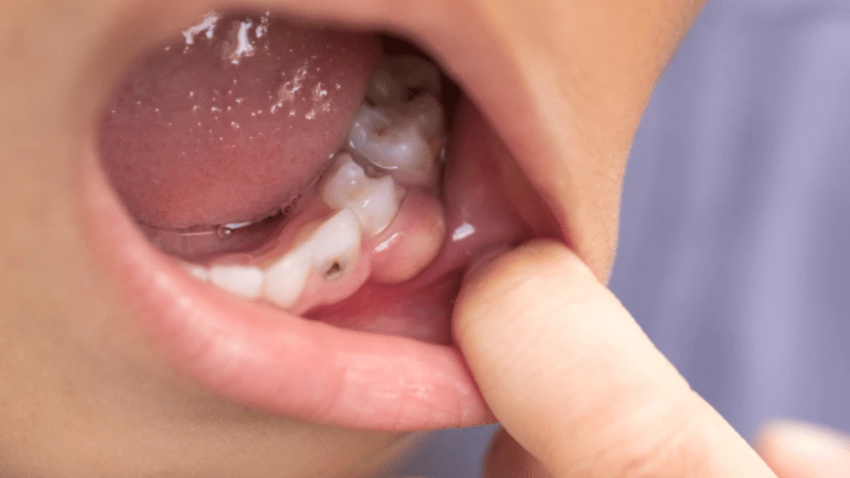Relieving Swelling and Pain Options in Emergency Dentistry