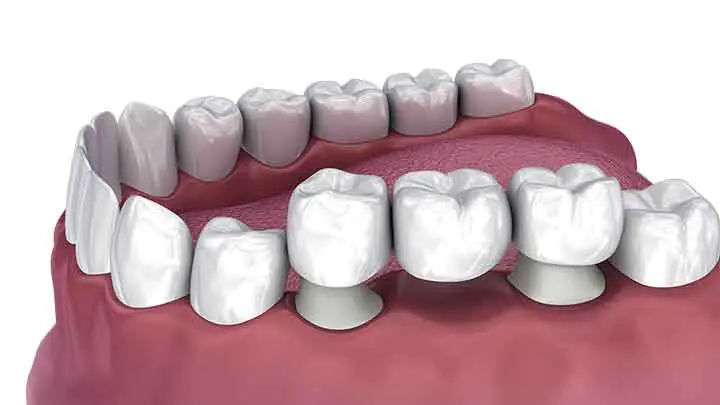 dental-bridge-three-teeth-3d-illustration