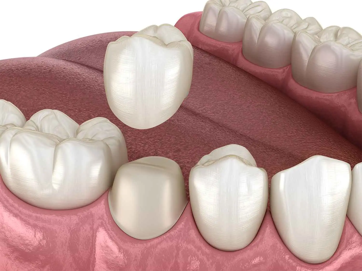 dental-crown-3d-illustration
