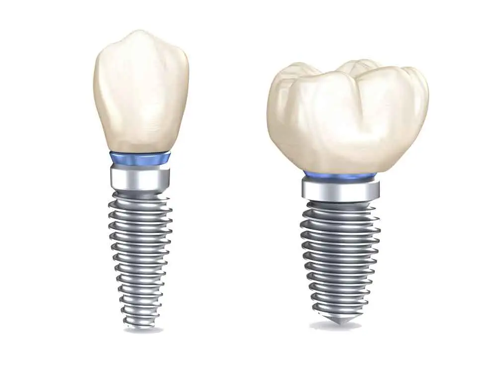 dental-implants-3d-illustration-of-human-teeth
