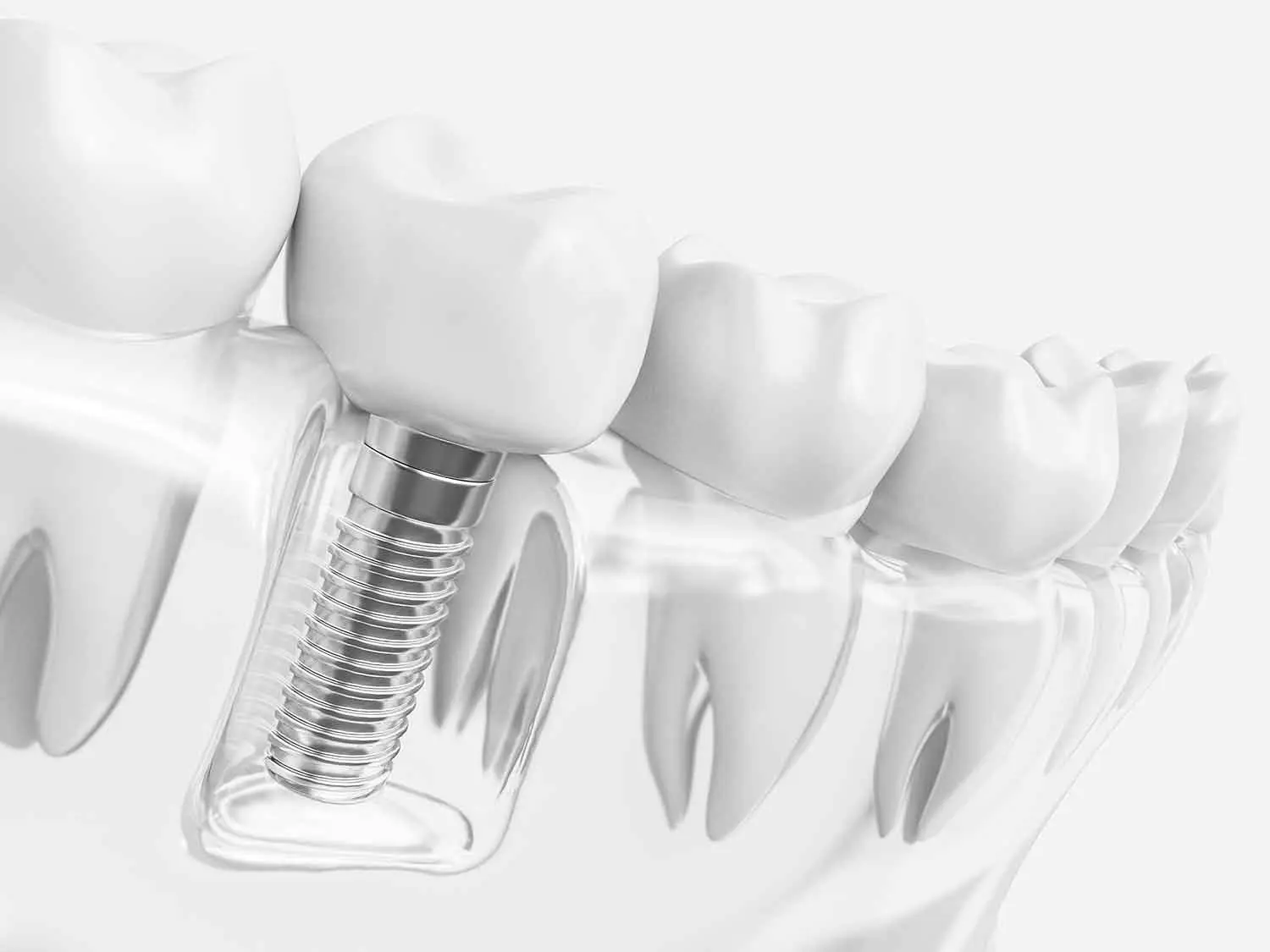 human-tooth-implant