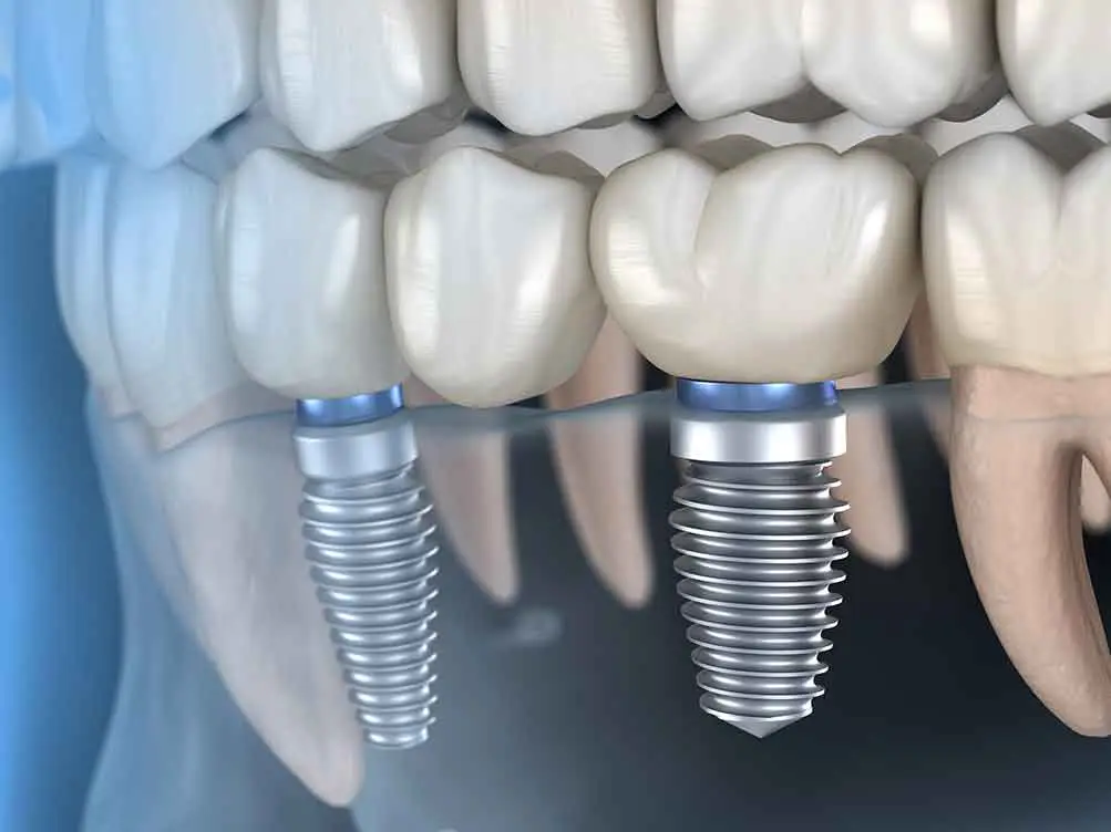 implant-supported-bridge-3d-illustration